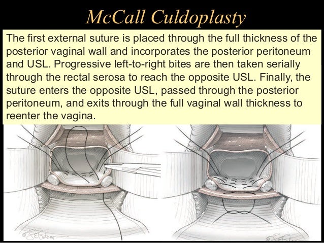 total vaginal hysterectomy mccalls Old guys dick